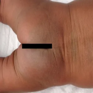 Plamy na pośladkach u dziecka