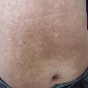 Plamy na skórze brzucha amyloidozy skóry 