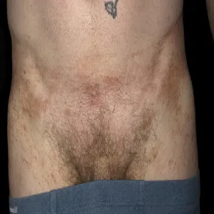 Plamy na skórze u mężczyzn 