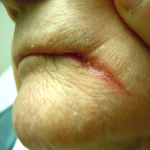 Plamy w kącikach ust