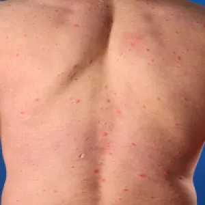 Początek ospy wietrznej