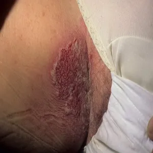 Podrażnienia, rany w okolicach intymnych choroba Haileya-Haileya