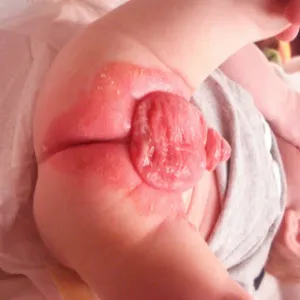 Podrażnienie skóry okolicy wewnętrznej strony ud u niemowląt 