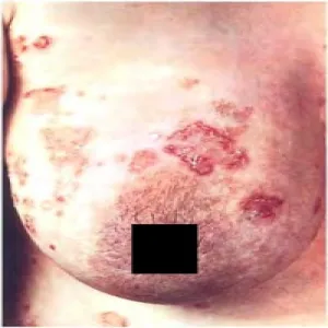 Podrogowa dermatoza krostkowa na piersi