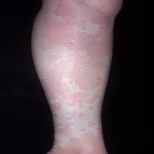 Pokrzywka alergiczna na słońce