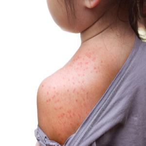 Pokrzywka alergiczna uczulenie na cytrusy u dzieci wysypka