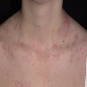 Pokrzywka cholinergiczna na skórze