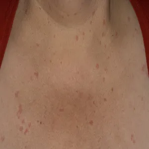 Pokrzywka cholinergiczna zdjęcie