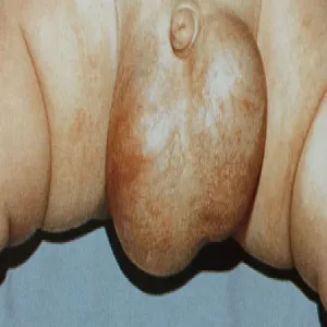 Powiększenie jąder u dziecka wodniak