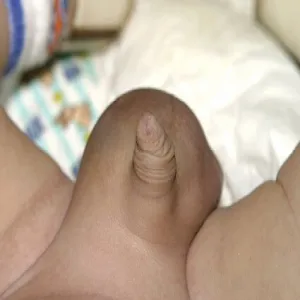 Powiększona moszna u dziecka wodniak jądra