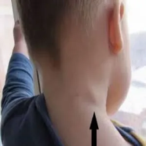 Powiększone węzły chłonne na szyi