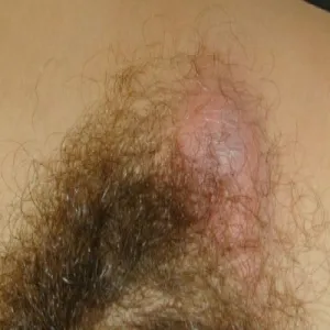 Powiększony jeden węzeł chłonny w pachwinie