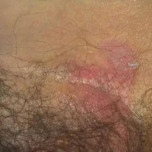 Pozasutkowa choroba Pageta zdjęcie