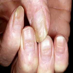 Poziome bruzdy na paznokciach