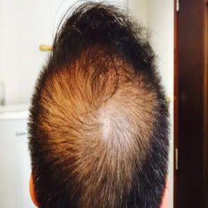 Prześwit na czubku głowy łysienie androgenowe u mężczyzn 