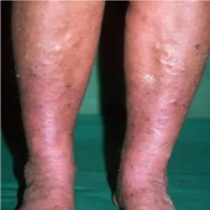 Przebarwienia na nogach wyprysk podudzi