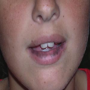Przebarwienia na ustach choroba Addisona 