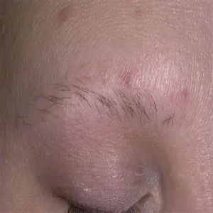 Przerzedzenie brwi łysienie plackowate