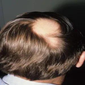 Przerzedzenie włosów na czubku głowy