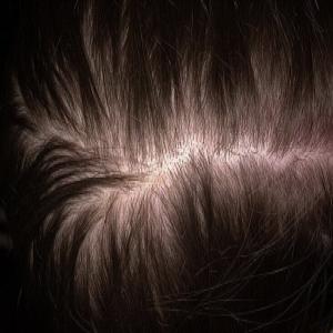 Przerzedzone włosy na przedziałku łysienie androgenowe 
