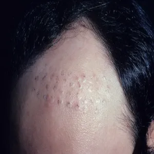 Przerzedzone włosy po bokach łysienie androgenowe 