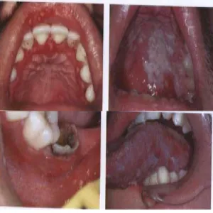 Przewlekła hiperplastyczna grzybica zdjęcie