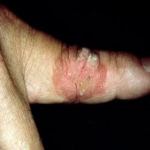 Rak kolczystokomórkowy na palcu choroba Bowena