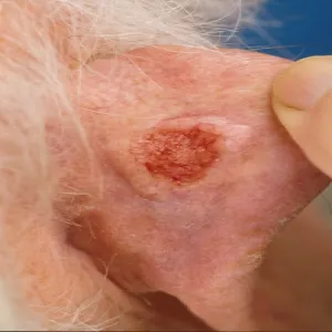 Rak podstawnokomórkowy skóry ucha