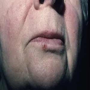 Rak podstawnokomórkowy skóry ust