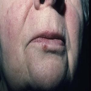 Rak podstawnokomórkowy skóry ust
