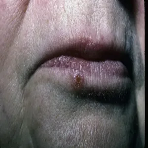 Rak podstawnokomórkowy skóry wargi