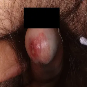 Rak przedinwazyjny prącia 