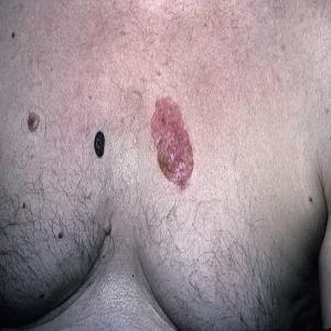 Rak skóry na klatce piersiowej choroba Bowena