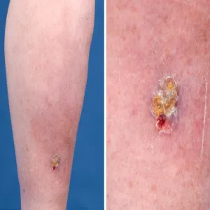 Rak skóry na nodze choroba Bowena