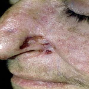 Rak skóry na nosie