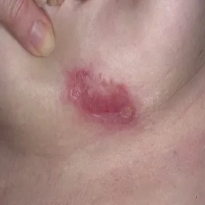 Rak skóry piersi choroba Bowena