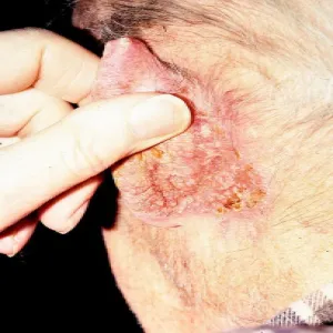 Rak ucha choroba Bowena