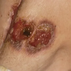 Rana wokół stomii piodermia zgorzelinowa