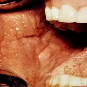 Rogowacenie ciemne w jamie ustnej