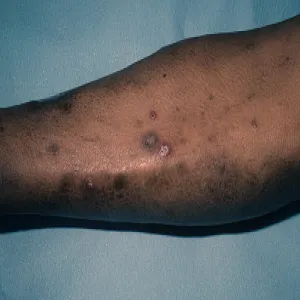 Rogowacenie okołomieszkowe