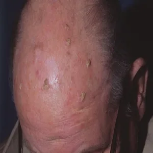 Rogowacenie słoneczne na skórze głowy