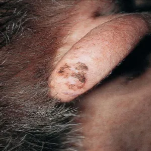 Rogowacenie słoneczne na uchu