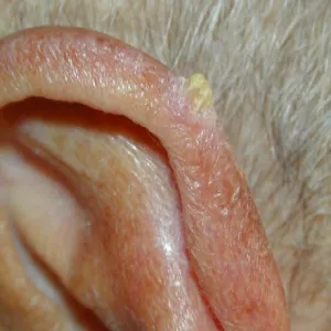 Rogowacenie starcze na uchu