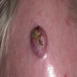 Rogowiak kolczystokomórkowy (keratoacanthoma)