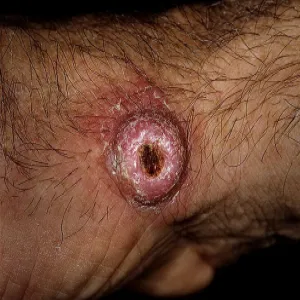 Rogowiak kolczystokomórkowy choroba skórna