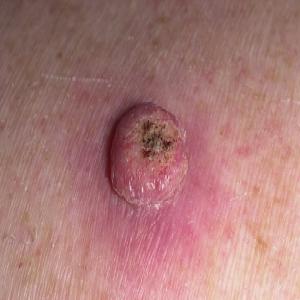 Rogowiak kolczystokomórkowy choroby skóry