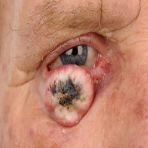Rogowiak kolczystokomórkowy guz na oku
