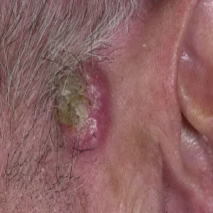 Rogowiak kolczystokomórkowy guz za uchem
