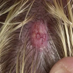 Rogowiak kolczystokomórkowy guzek na skórze głowy