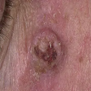 Rogowiak kolczystokomórkowy pod okiem